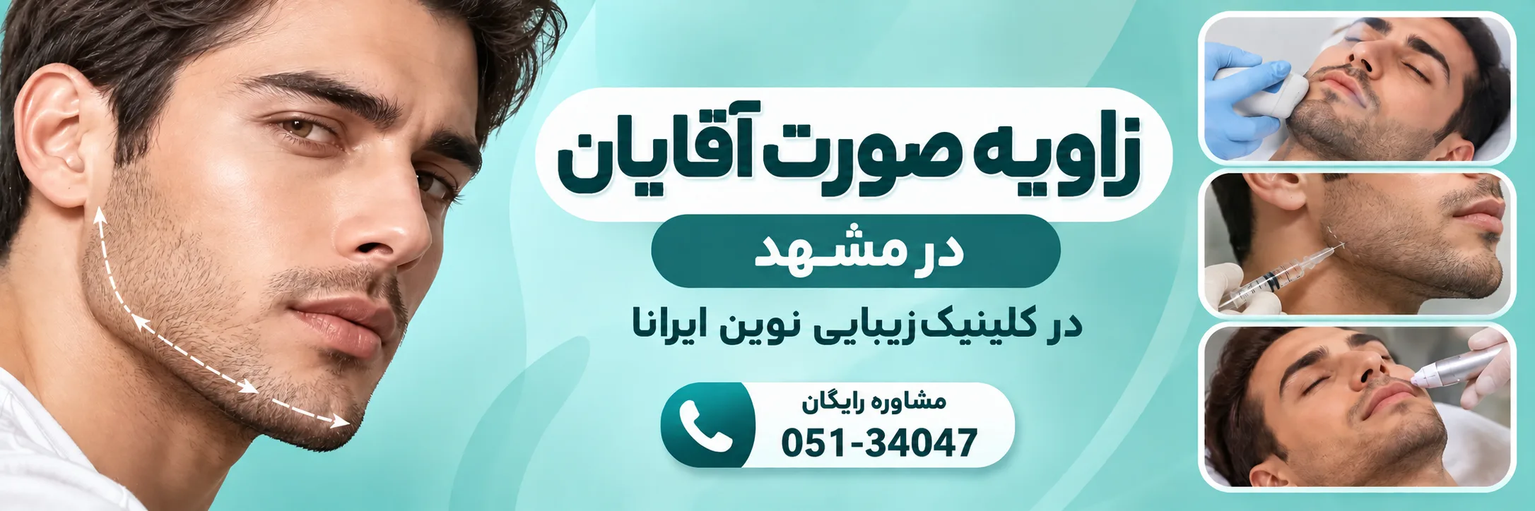 زاویه سازی صورت آقایان در کلینیک نوین ایرانا